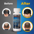 Kirkland Signature Men’s Hair Regrowth Treatment – Extra Strength 5% Minoxidil Topical Solution (6 Month Supply)