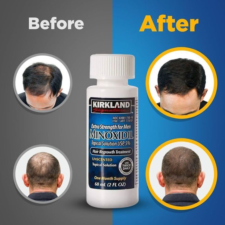Kirkland Signature Men’s Hair Regrowth Treatment – Extra Strength 5% Minoxidil Topical Solution (6 Month Supply)
